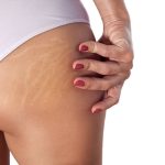 Woman buttocks with visible stretch marks and cellulite