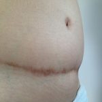 Scars from surgery abdominal area.